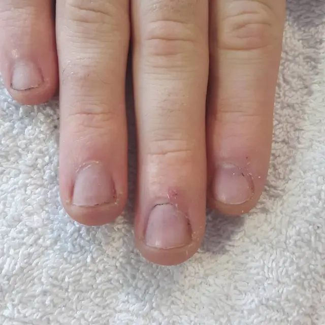 Manucure sur ongles rongés.