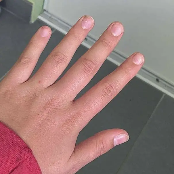 Pose de semi-permanent sur ongles extrêmement court en attendant qu'ils repoussent.