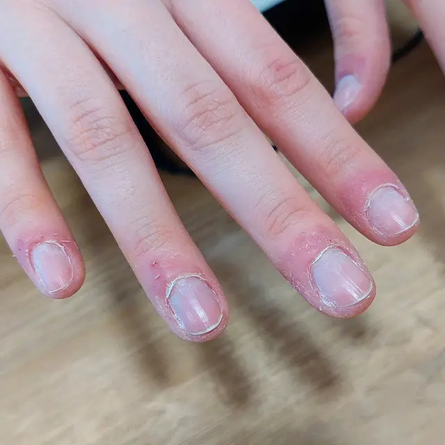 Sauvons ces peaux et ongles martyrisés !