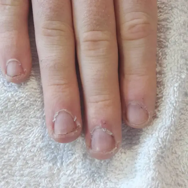 Manucure sur ongles rongés.