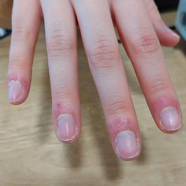 Sauvons ces peaux et ongles martyrisés !